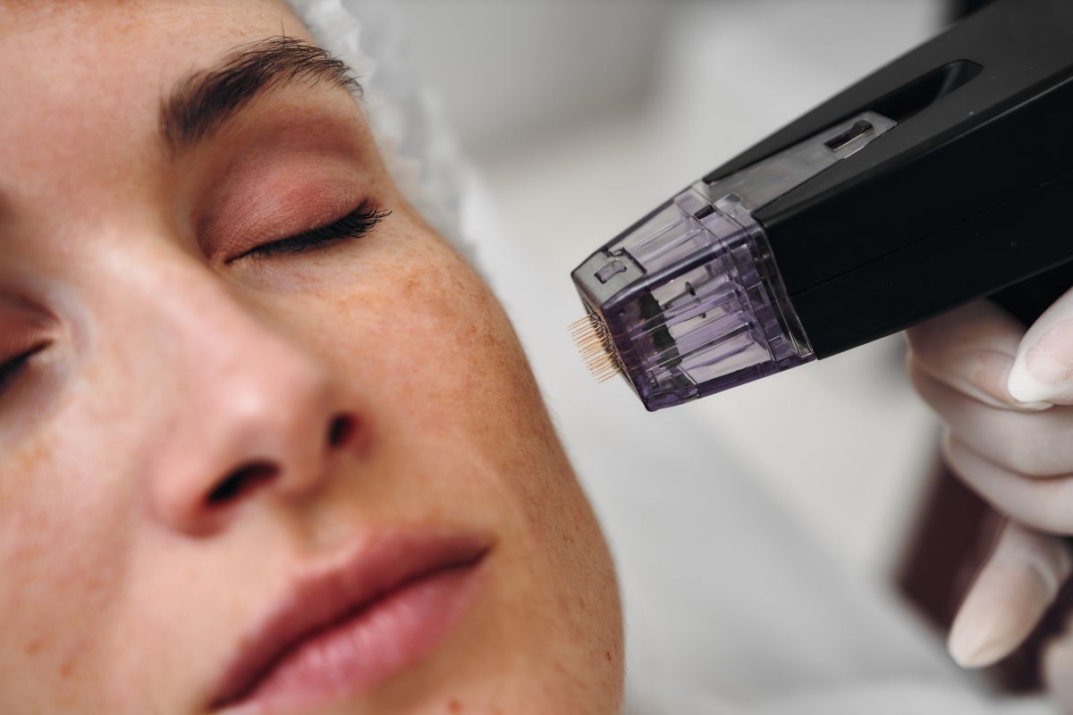 woman gets microneedling